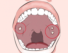 口腔溃疡经久不愈？警惕癌前病变！