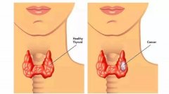 结节？肿块？看看被你忽视误解的甲状腺